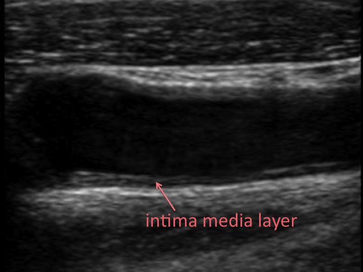 Carotid Intima-Media Thickness (CIMT) Test